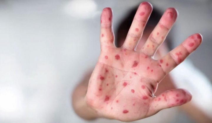 Two new cases of measles in Greater Victoria prompts exposure warning